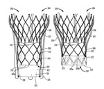 US10143551B2-patent-drawing