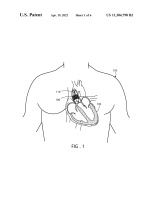 US11304798B2-patent-drawing