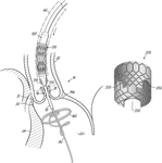 US11484370B1-patent-drawing