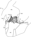 US11510777B1-patent-drawing