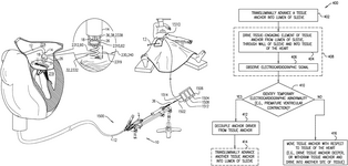 US12274618B2-patent-drawing