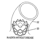 US20160279297A1-patent-drawing
