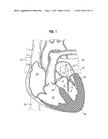 US20170231759A1-patent-drawing