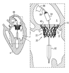 US2018338831A1-patent-drawing