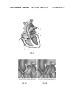 US20200229918A1-patent-drawing